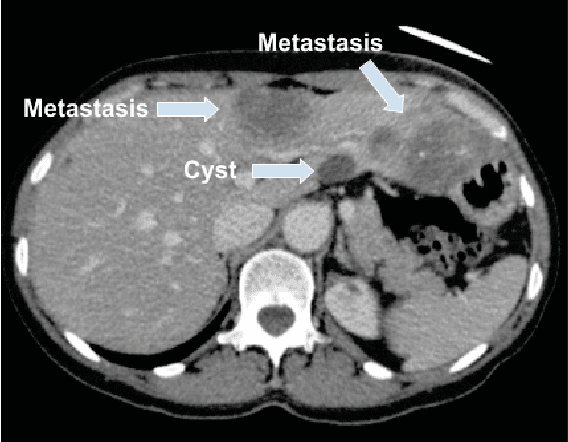 Figure 1 for End-to-End Discriminative Deep Network for Liver Lesion Classification