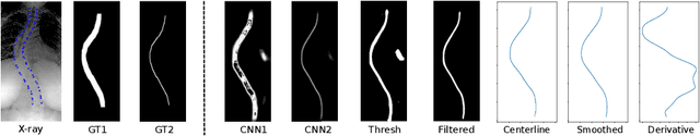 Figure 1 for Automated Estimation of the Spinal Curvature via Spine Centerline Extraction with Ensembles of Cascaded Neural Networks