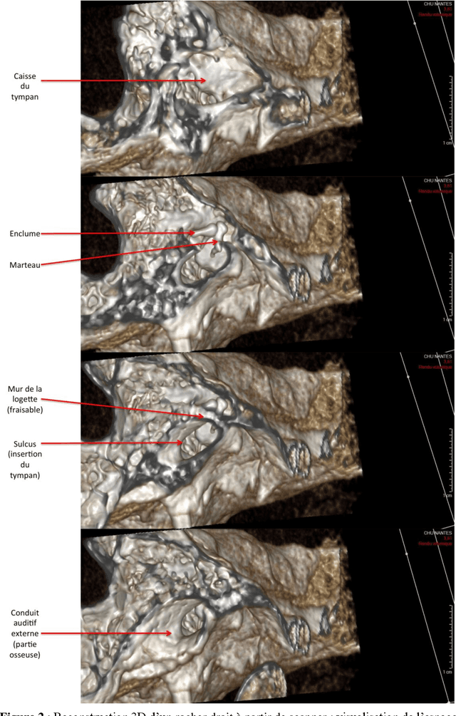 Figure 2 for Analyse du besoin en assistance robotique dans la chirurgie de l'oreille