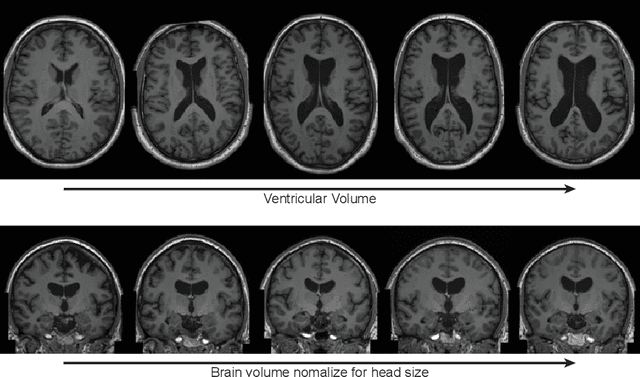 Figure 3 for Brain Imaging Generation with Latent Diffusion Models