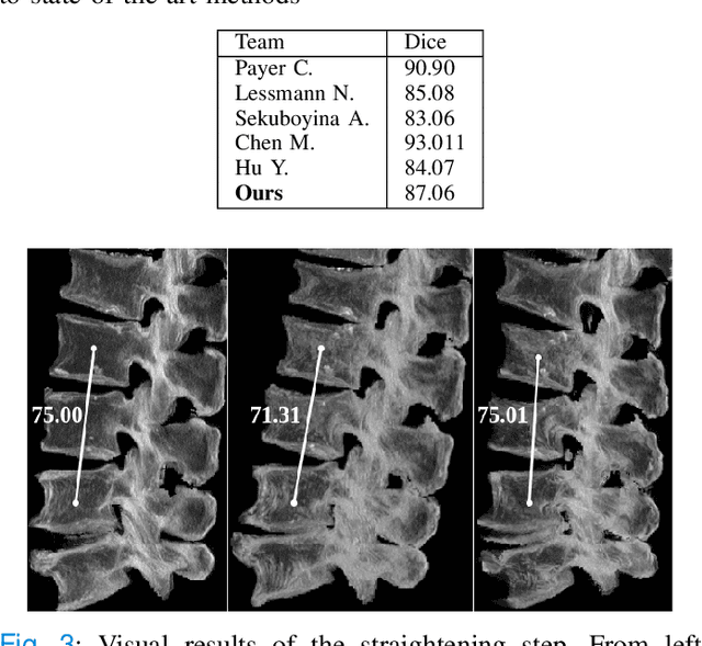 Figure 3 for Patient-specific virtual spine straightening and vertebra inpainting: An automatic framework for osteoplasty planning