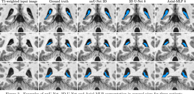 Figure 4 for Axial multi-layer perceptron architecture for automatic segmentation of choroid plexus in multiple sclerosis