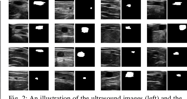 Figure 2 for VeniBot: Towards Autonomous Venipuncture with Semi-supervised Vein Segmentation from Ultrasound Images
