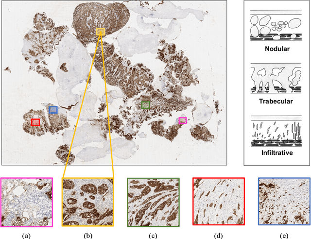 Figure 1 for A Novel Self-Learning Framework for Bladder Cancer Grading Using Histopathological Images