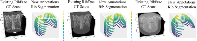 Figure 1 for RibSeg Dataset and Strong Point Cloud Baselines for Rib Segmentation from CT Scans