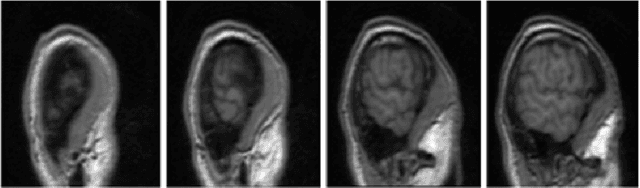 Figure 4 for Accurate brain extraction using Active Shape Model and Convolutional Neural Networks