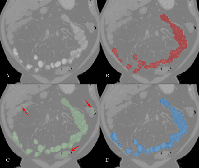 Figure 3 for Deep Small Bowel Segmentation with Cylindrical Topological Constraints