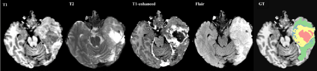 Figure 3 for Distributing Deep Learning Hyperparameter Tuning for 3D Medical Image Segmentation