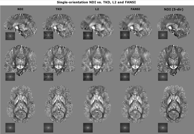 Figure 4 for Nonlinear Dipole Inversion (NDI) enables Quantitative Susceptibility Mapping (QSM) without parameter tuning