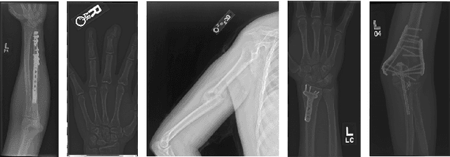 Figure 1 for Self-Taught Semi-Supervised Anomaly Detection on Upper Limb X-rays