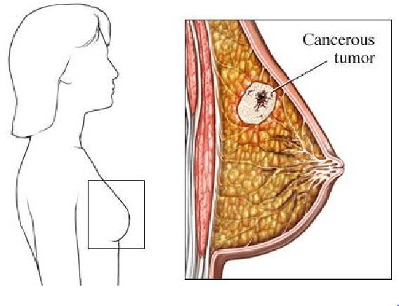 Figure 1 for Automatic Mass Detection in Breast Using Deep Convolutional Neural Network and SVM Classifier