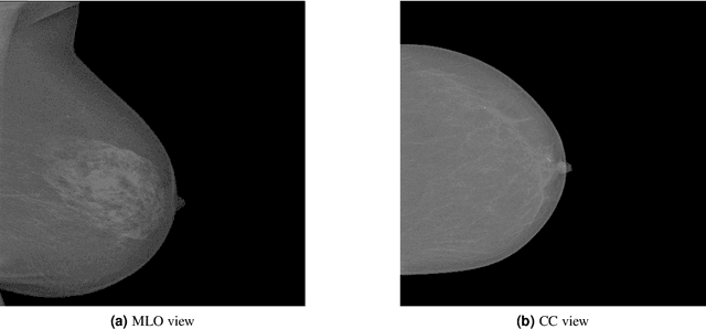 Figure 3 for Automatic Mass Detection in Breast Using Deep Convolutional Neural Network and SVM Classifier