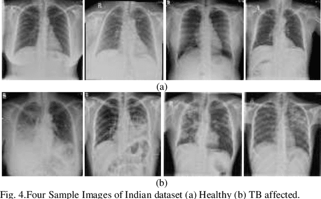 Figure 4 for Deep Learning for Automated Screening of Tuberculosis from Indian Chest X-rays: Analysis and Update