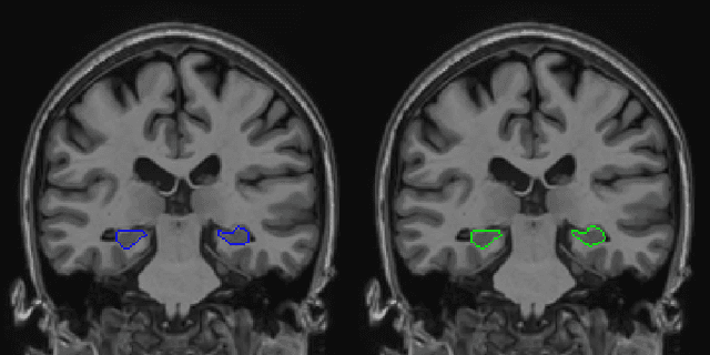 Figure 1 for Extended 2D Volumetric Consensus Hippocampus Segmentation