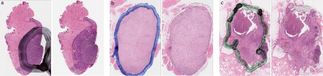 Figure 4 for Restoration of marker occluded hematoxylin and eosin stained whole slide histology images using generative adversarial networks