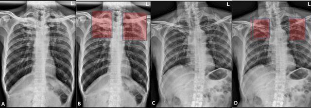 Figure 4 for Role of Edge Device and Cloud Machine Learning in Point-of-Care Solutions Using Imaging Diagnostics for Population Screening