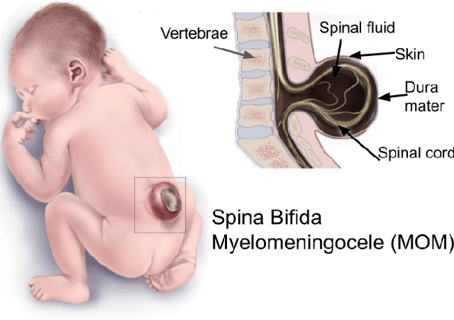 Figure 1 for Virtual Reality Simulator for Fetoscopic Spina Bifida Repair Surgery