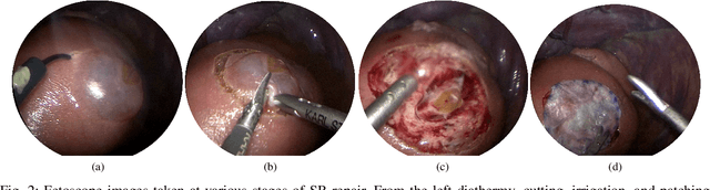 Figure 2 for Virtual Reality Simulator for Fetoscopic Spina Bifida Repair Surgery