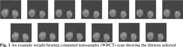 Figure 2 for The use of deep learning enables high diagnostic accuracy in detecting syndesmotic instability on weight-bearing CT scanning