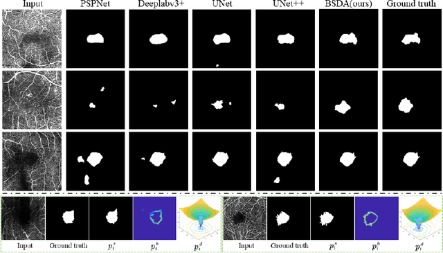 Figure 3 for BSDA-Net: A Boundary Shape and Distance Aware Joint Learning Framework for Segmenting and Classifying OCTA Images