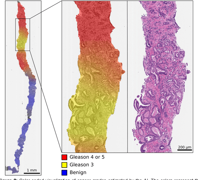 Figure 3 for Pathologist-Level Grading of Prostate Biopsies with Artificial Intelligence