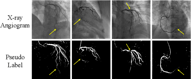 Figure 1 for Weakly Supervised Vessel Segmentation in X-ray Angiograms by Self-Paced Learning from Noisy Labels with Suggestive Annotation