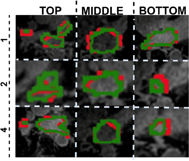 Figure 3 for V-FCNN: Volumetric Fully Convolution Neural Network For Automatic Atrial Segmentation
