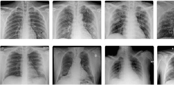 Figure 1 for A Data Augmented Approach to Transfer Learning for Covid-19 Detection