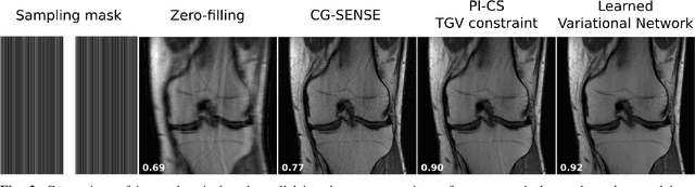 Figure 3 for Deep Learning Methods for Parallel Magnetic Resonance Image Reconstruction