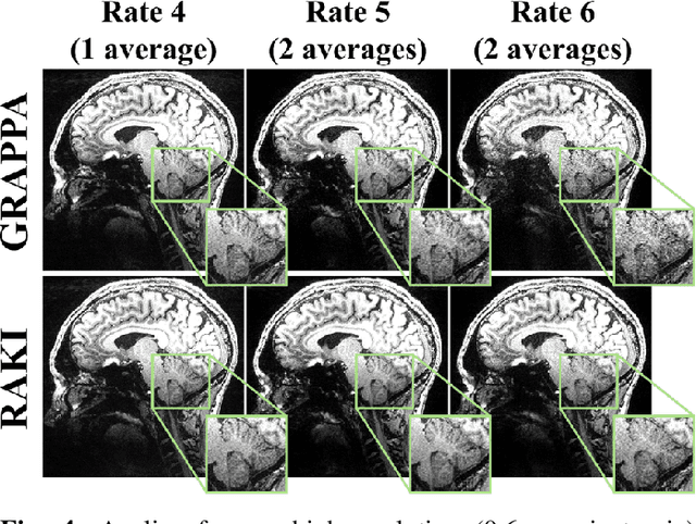 Figure 4 for Deep Learning Methods for Parallel Magnetic Resonance Image Reconstruction
