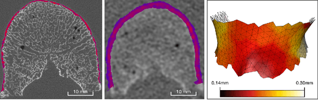 Figure 1 for An Analysis by Synthesis Method that Allows Accurate Spatial Modeling of Thickness of Cortical Bone from Clinical QCT