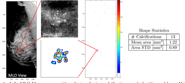 Figure 1 for Segmenting Microcalcifications in Mammograms and its Applications