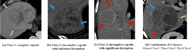 Figure 1 for Sequential Learning on Liver Tumor Boundary Semantics and Prognostic Biomarker Mining