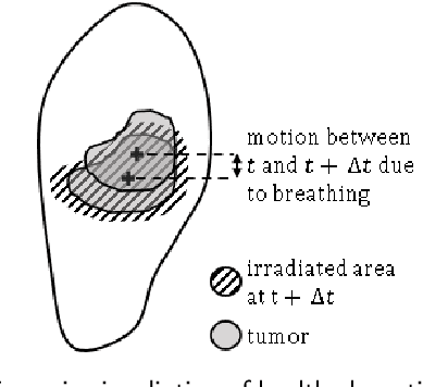 Figure 1 for Prediction of the motion of chest internal points using a recurrent neural network trained with real-time recurrent learning for latency compensation in lung cancer radiotherapy