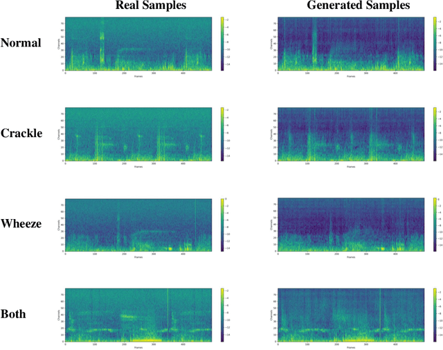 Figure 4 for Adversarial Fine-tuning using Generated Respiratory Sound to Address Class Imbalance