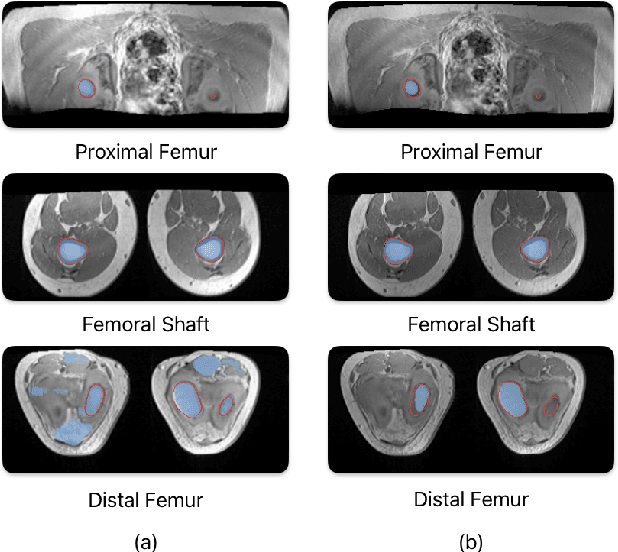 Figure 1 for Performance Analysis of Deep Learning Models for Femur Segmentation in MRI Scan