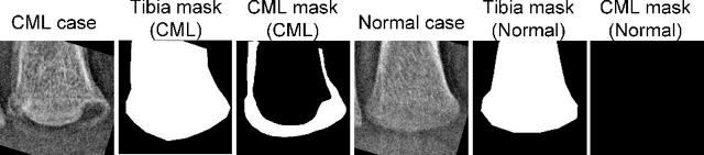Figure 3 for Masked Conditional Diffusion Models for Image Analysis with Application to Radiographic Diagnosis of Infant Abuse