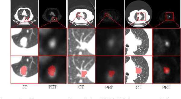 Figure 1 for Cross-Modal Interactive Perception Network with Mamba for Lung Tumor Segmentation in PET-CT Images