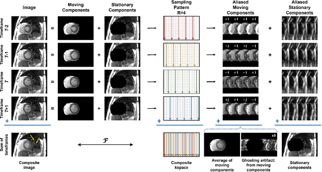 Figure 1 for Deep Learning Assisted Outer Volume Removal for Highly-Accelerated Real-Time Dynamic MRI