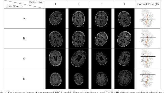Figure 4 for Using ResNet to Utilize 4-class T2-FLAIR Slice Classification Based on the Cholinergic Pathways Hyperintensities Scale for Pathological Aging