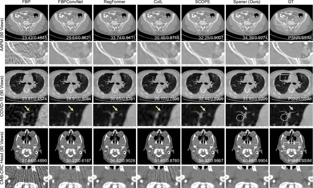 Figure 3 for Unsupervised Self-Prior Embedding Neural Representation for Iterative Sparse-View CT Reconstruction