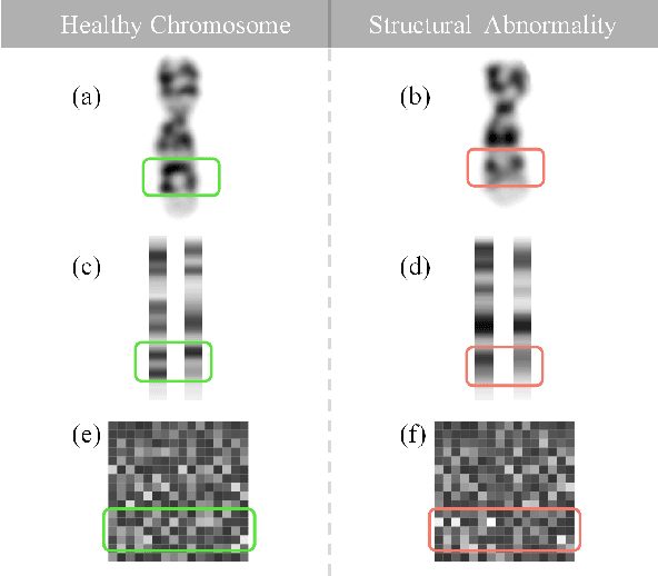 Figure 1 for Chromosomal Structural Abnormality Diagnosis by Homologous Similarity