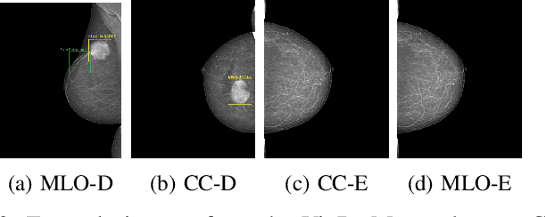Figure 3 for Improving Mass Detection in Mammography Images: A Study of Weakly Supervised Learning and Class Activation Map Methods