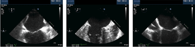 Figure 4 for Predicting Mitral Valve mTEER Surgery Outcomes Using Machine Learning and Deep Learning Techniques