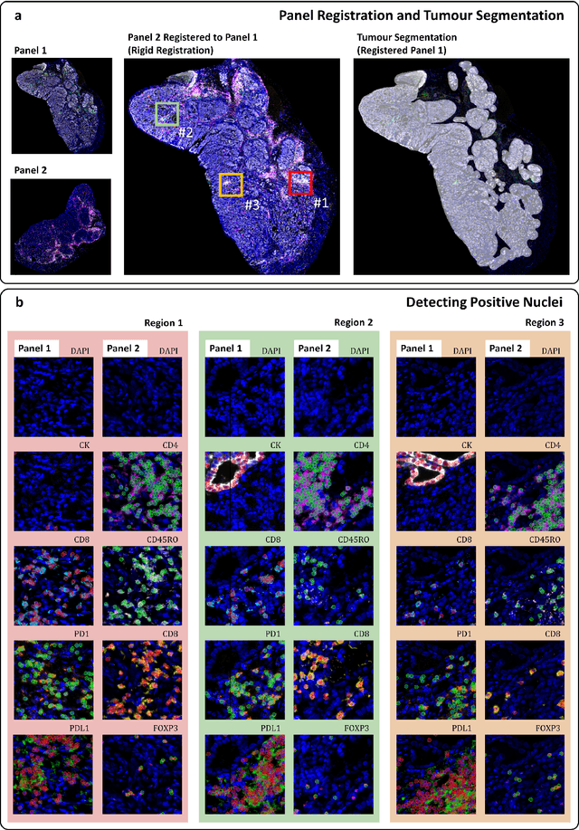 Figure 2 for An AI based Digital Score of Tumour-Immune Microenvironment Predicts Benefit to Maintenance Immunotherapy in Advanced Oesophagogastric Adenocarcinoma