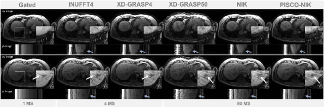 Figure 4 for Self-Supervised k-Space Regularization for Motion-Resolved Abdominal MRI Using Neural Implicit k-Space Representation