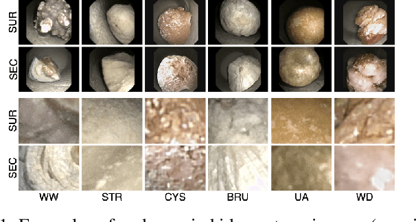 Figure 1 for Evaluation of Few-Shot Learning Methods for Kidney Stone Type Recognition in Ureteroscopy