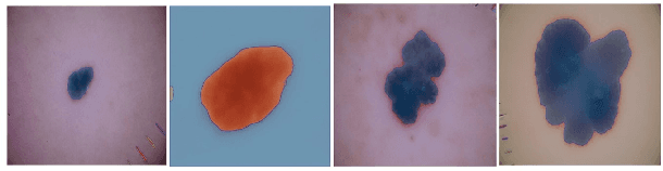 Figure 3 for Derm-T2IM: Harnessing Synthetic Skin Lesion Data via Stable Diffusion Models for Enhanced Skin Disease Classification using ViT and CNN