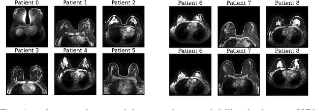 Figure 1 for GuidedMorph: Two-Stage Deformable Registration for Breast MRI