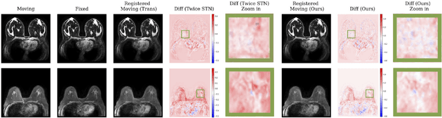 Figure 2 for GuidedMorph: Two-Stage Deformable Registration for Breast MRI